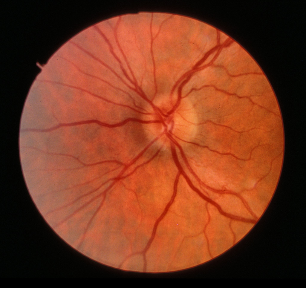 Early progression of cupping can be seen by comparing sequential photographs of the optic nerve. The optic cup which was initially not visible 